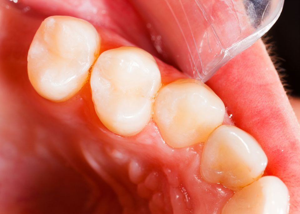 Tooth-Colored Fillings