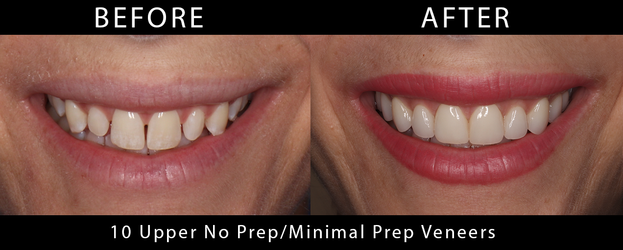 10_UpperNoPrepMinimalPrepVeneers