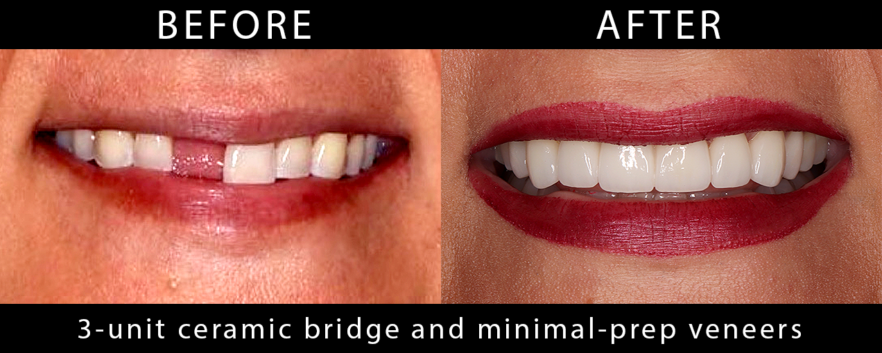 3UnitCeramicBridgeMinimalPrepVeneers