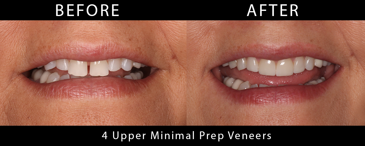 4_UpperNoPrepMinimalPrepVeneers