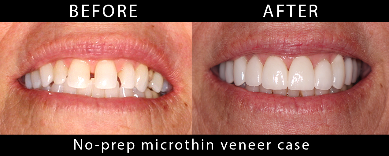 NoPrepMicrothinVeneer