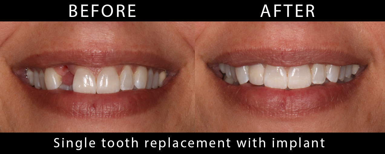 SingleToothReplacementImplant