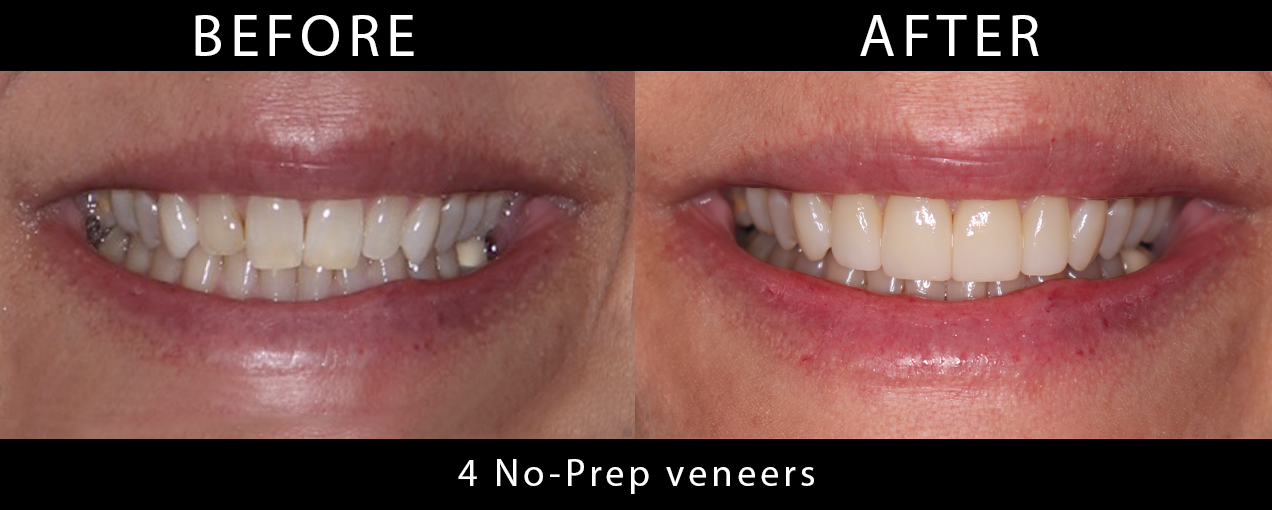 four_no_prep_veneers