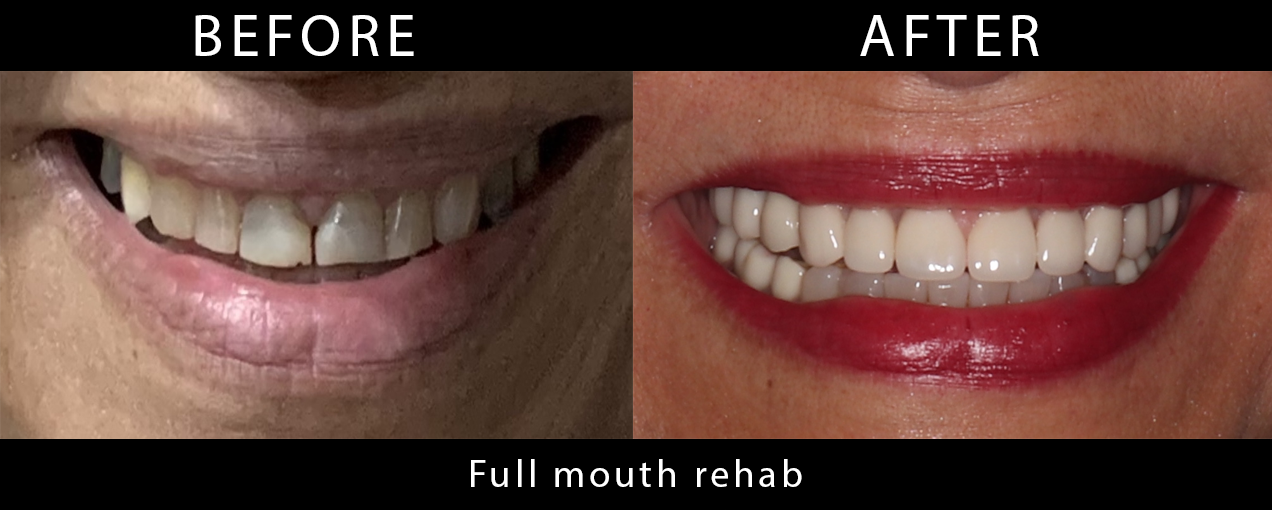 full_mouth_rehab
