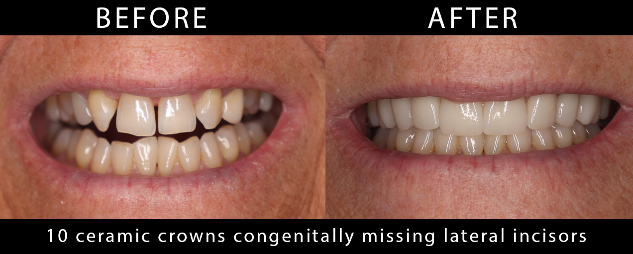 ten_ceramic_crowns_congenitally_missing_lateral_incisors